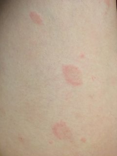何週間からまえから出てる輪っか状の湿疹