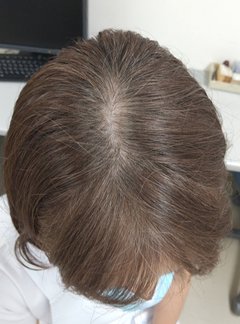 【白髪】レストリアディスクリートについて