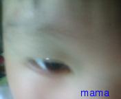 子供が叩かれて痣ができた