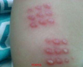 BCG予防接種からもうすぐ4ヶ月、こんなに赤いもの？【写あり】