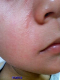 【写あり】この発疹分かる方いますか？