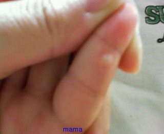 子供の手に水泡(写あり)