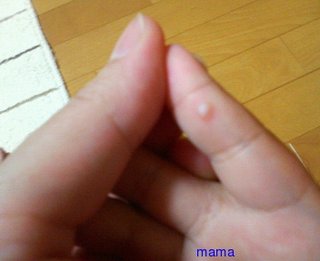 子供の手に水泡(写あり)