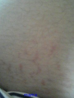 これって妊娠線？