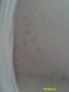 これって妊娠線？