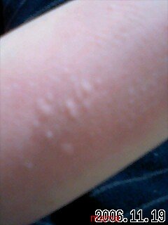 じんましんでしょうか？【写あり】