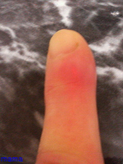 【汚い写】人指し指が腫れているんだけど