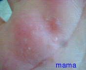 主婦湿疹ってどんなの？【写有り】