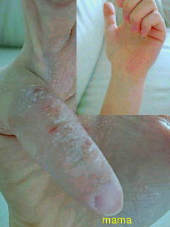 手湿疹・主婦湿疹ある方