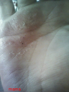 手湿疹・主婦湿疹ある方