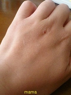 手湿疹・主婦湿疹ある方