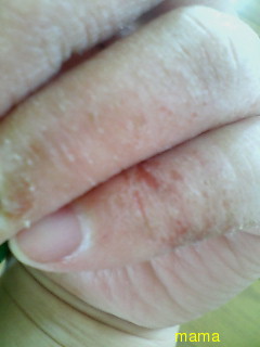 手湿疹・主婦湿疹ある方