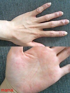 手湿疹・主婦湿疹ある方