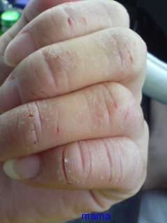 手湿疹・主婦湿疹ある方