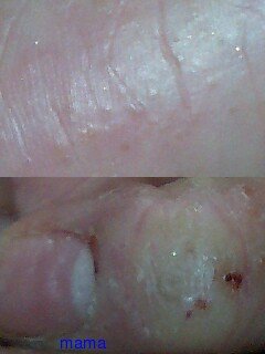 手湿疹・主婦湿疹ある方