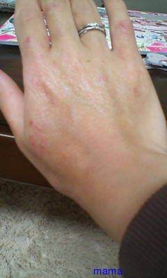 手湿疹・主婦湿疹ある方