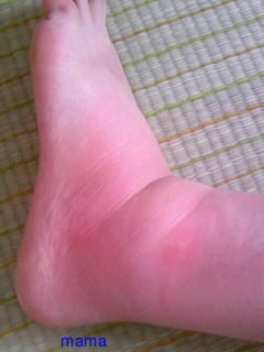 蚊に刺されて【写】