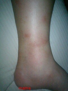 蚊に刺されて【写】