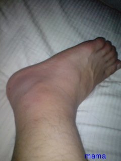 蚊に刺されて【写】