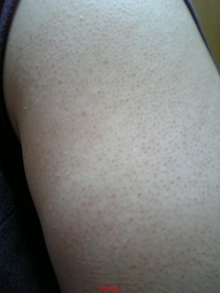 二の腕のブツブツは