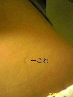 これって妊娠線？写あり