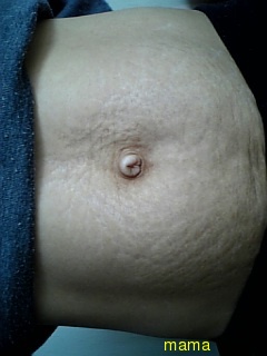 本当ひどすぎる妊娠線。。見たら驚くと思います↓