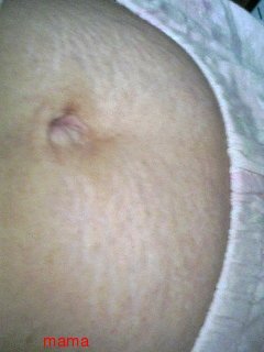 妊娠線 【グロ写】