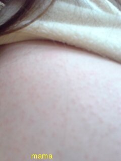 妊娠線クリームで湿疹？！