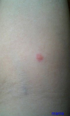 これはダニに刺された跡？