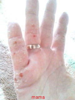 手湿疹、主婦湿疹のひどい方。【グロ画あり】
