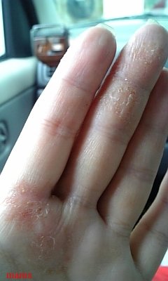 手湿疹、主婦湿疹のひどい方。【グロ画あり】