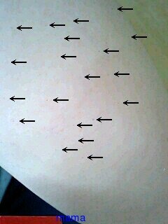 二の腕に赤いﾌﾟﾂﾌﾟﾂ。。