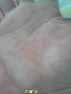 これって主婦湿疹？【写あり】