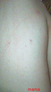 ただの内出血でしょうか？