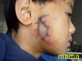中国で教師が生徒の頬を引きちぎる【写あり:注意！】