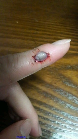 指の切り傷(グロ写有)