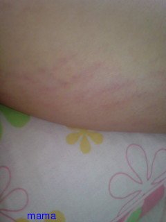 みんな妊娠線て