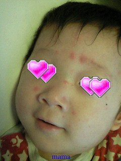 ９ヶ月で水疱瘡？【写】