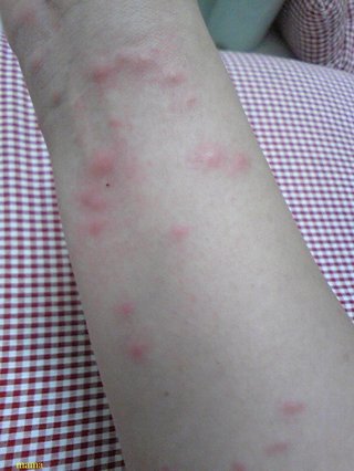 これは何ですか？(腕にブツブツ、画像グロいかも)