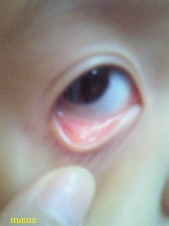貧血？下まぶたの裏　写ｱﾘ