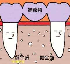 抜歯後のブリッジ!?について詳しい人