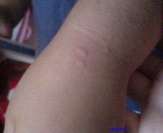 写ｱﾘ。蚊にさされたような発疹