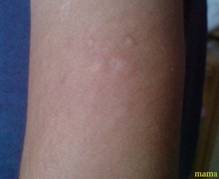 写ｱﾘ。蚊にさされたような発疹