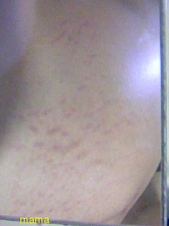 【グロ】妊娠線