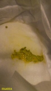 ◆赤ちゃんの難病「胆道閉鎖症」◆