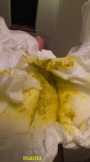 ◆赤ちゃんの難病「胆道閉鎖症」◆