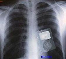 患者体内にiPod置き忘れ 滋賀・びわこ医大病院