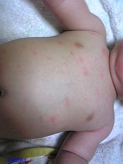 生後5ヶ月、お風呂に入ると湿疹【写ｱﾘ】