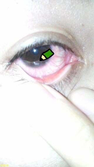 目に白い傷が…(超グロ写です)