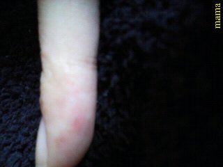 主婦湿疹？手湿疹？